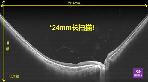 圖湃醫(yī)療亮相2021中國眼底病論壇 24mm血流成像技術(shù)引領(lǐng)眼底診斷新高度